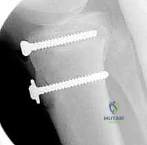 صورة توضيحية لـ كسر حدبة الظنبوب: دليل شامل لعلاج الرد المفتوح والتثبيت الداخلي مع الأستاذ الدكتور محمد هطيف في صنعاء
