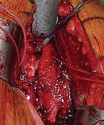 صورة توضيحية لـ كسور الجزء الداني من عظم العضد: دليل شامل للعلاج والتعافي مع الأستاذ الدكتور محمد هطيف