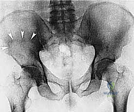 Pelvic Resection: An Intraoperative Masterclass in Complex Oncologic Surgery