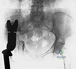 Orthopedic Prometric MCQs - Chapter 3 Part 36
