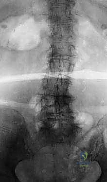 Mastering Adult Scoliosis: Intraoperative Techniques for Deformity Correction