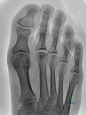 Illustration of cheilectomy for hallux - Dr. Mohammed Hutaif