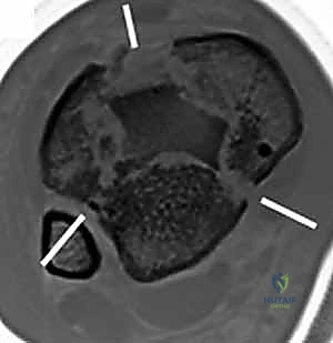 Illustration of tibial plafond fractures - Dr. Mohammed Hutaif