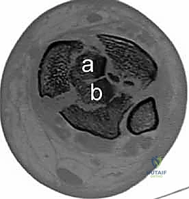 Skeletal Dysplasias: Anarchic Bone Development MCQs