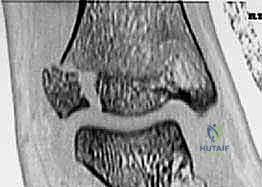 صورة توضيحية لـ كسور كاحل الأطفال: دليلك الشامل للعلاج الجراحي المتقن في صنعاء مع الأستاذ الدكتور محمد هطيف