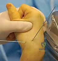 صورة توضيحية لـ علاج عدم التئام العظم الزورقي بالتدخل المحدود الحل الأمثل لآلام الرسغ في صنعاء مع الأستاذ الدكتور محمد هطيف