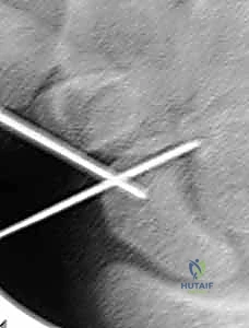 التشريح الدقيق للعظم الزورقي وموقعه في الرسغ