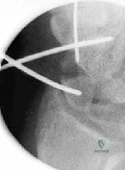 التخطيط الجراحي لعملية التدخل المحدود