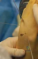 صورة توضيحية لـ علاج عدم التئام العظم الزورقي بالتدخل المحدود الحل الأمثل لآلام الرسغ في صنعاء مع الأستاذ الدكتور محمد هطيف