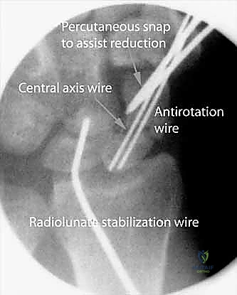صورة توضيحية لـ علاج عدم التئام العظم الزورقي بالتدخل المحدود الحل الأمثل لآلام الرسغ في صنعاء مع الأستاذ الدكتور محمد هطيف
