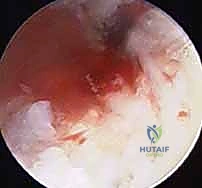 صورة توضيحية لـ علاج عدم التئام العظم الزورقي بالتدخل المحدود الحل الأمثل لآلام الرسغ في صنعاء مع الأستاذ الدكتور محمد هطيف