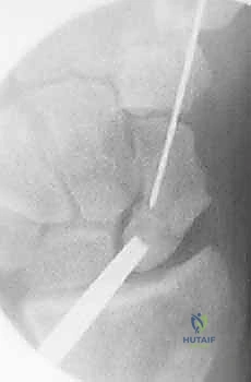 صورة توضيحية لـ علاج عدم التئام العظم الزورقي بالتدخل المحدود الحل الأمثل لآلام الرسغ في صنعاء مع الأستاذ الدكتور محمد هطيف