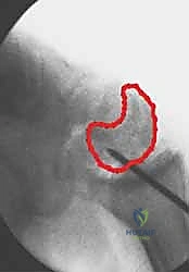 صورة طبية: علاج عدم التئام العظم الزورقي بالتدخل المحدود الحل الأمثل لآلام الرسغ في صنعاء مع الأستاذ الدكتور محمد هطيف