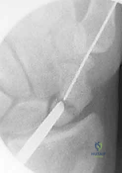 صورة توضيحية لـ علاج عدم التئام العظم الزورقي بالتدخل المحدود الحل الأمثل لآلام الرسغ في صنعاء مع الأستاذ الدكتور محمد هطيف