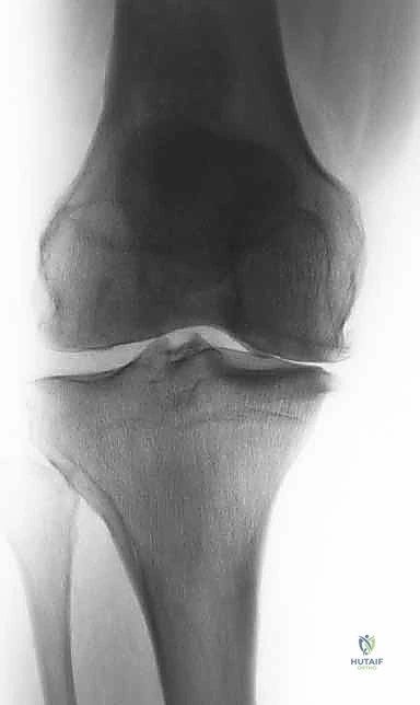 دقة التخطيط الجراحي مع الدكتور هطيف