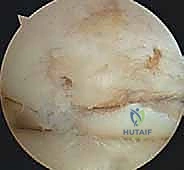 تخطيط جراحي دقيق لعملية HTO