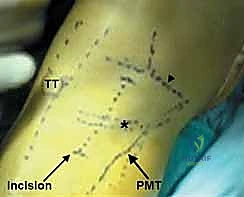 صورة شعاعية توضح التقوس