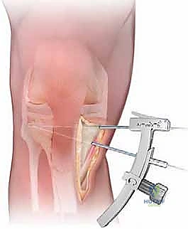 صورة طبية: عملية قطع عظم الظنبوب القاصي (HTO): إعادة محاذاة الركبة لاستعادة الحياة النشطة مع الأستاذ الدكتور محمد هطيف