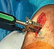 صورة توضيحية لـ عملية قطع عظم الظنبوب القاصي (HTO): إعادة محاذاة الركبة لاستعادة الحياة النشطة مع الأستاذ الدكتور محمد هطيف