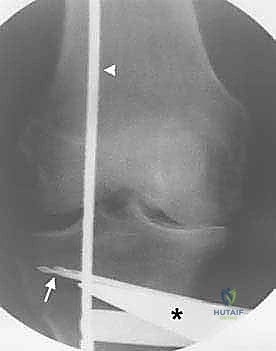 صورة توضيحية لـ عملية قطع عظم الظنبوب القاصي (HTO): إعادة محاذاة الركبة لاستعادة الحياة النشطة مع الأستاذ الدكتور محمد هطيف