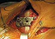 عملية قطع عظم الظنبوب القاصي (HTO): إعادة محاذاة الركبة لاستعادة الحياة النشطة مع الأستاذ الدكتور محمد هطيف