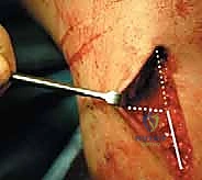 صورة طبية: عملية قطع عظم الظنبوب القاصي (HTO): إعادة محاذاة الركبة لاستعادة الحياة النشطة مع الأستاذ الدكتور محمد هطيف