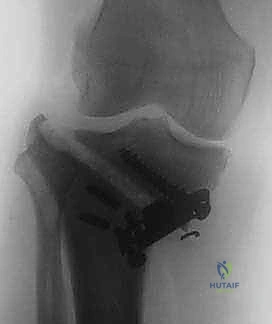 صورة طبية: عملية قطع عظم الظنبوب القاصي (HTO): إعادة محاذاة الركبة لاستعادة الحياة النشطة مع الأستاذ الدكتور محمد هطيف