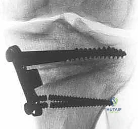 تقييم حالة المفصل بالأشعة