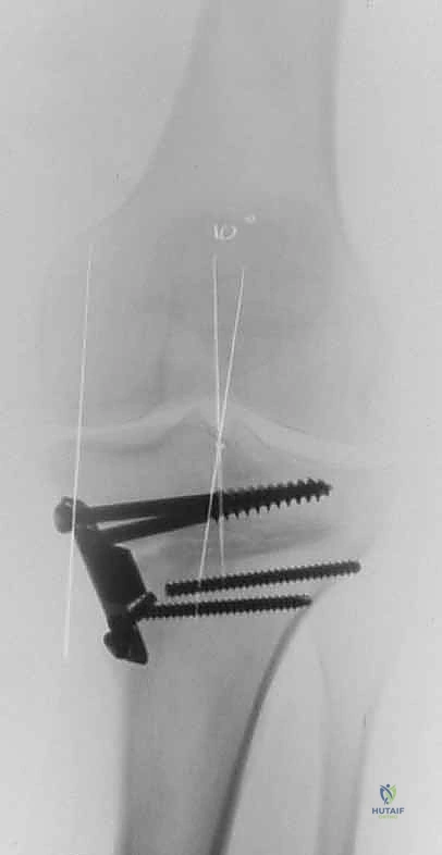 Illustration of guide pin assembly - Dr. Mohammed Hutaif