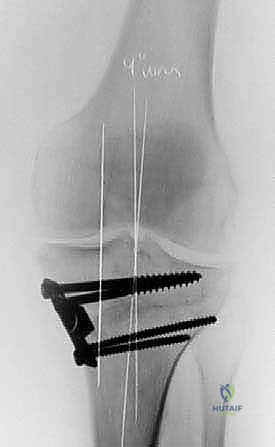 صورة طبية: عملية قطع عظم الظنبوب القاصي (HTO): إعادة محاذاة الركبة لاستعادة الحياة النشطة مع الأستاذ الدكتور محمد هطيف