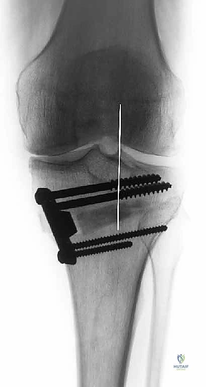 صورة طبية: عملية قطع عظم الظنبوب القاصي (HTO): إعادة محاذاة الركبة لاستعادة الحياة النشطة مع الأستاذ الدكتور محمد هطيف