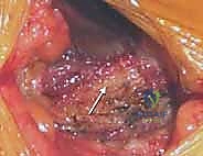 صورة توضيحية لـ إتقان زراعة العظم من حرقفة الحوض: دليل شامل للمرضى مع الأستاذ الدكتور محمد هطيف
