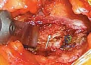 صورة توضيحية لـ إتقان زراعة العظم من حرقفة الحوض: دليل شامل للمرضى مع الأستاذ الدكتور محمد هطيف