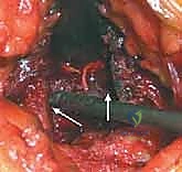 صورة توضيحية لـ إتقان زراعة العظم من حرقفة الحوض: دليل شامل للمرضى مع الأستاذ الدكتور محمد هطيف