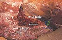 صورة توضيحية لـ إتقان زراعة العظم من حرقفة الحوض: دليل شامل للمرضى مع الأستاذ الدكتور محمد هطيف