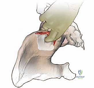 صورة طبية: إتقان زراعة العظم من حرقفة الحوض: دليل شامل للمرضى مع الأستاذ الدكتور محمد هطيف