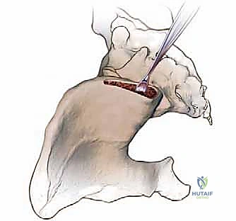 صورة توضيحية لـ إتقان زراعة العظم من حرقفة الحوض: دليل شامل للمرضى مع الأستاذ الدكتور محمد هطيف