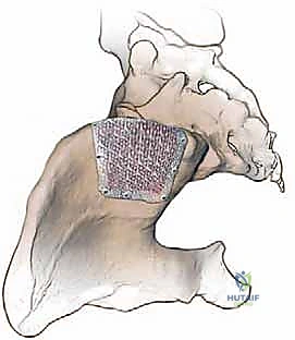 صورة توضيحية لـ إتقان زراعة العظم من حرقفة الحوض: دليل شامل للمرضى مع الأستاذ الدكتور محمد هطيف