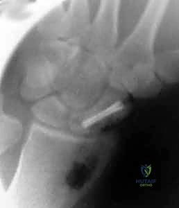صورة توضيحية لـ علاج عدم التئام العظم الزورقي بالرسغ: ترقيع العظم وتثبيت داخلي مع الأستاذ الدكتور محمد هطيف