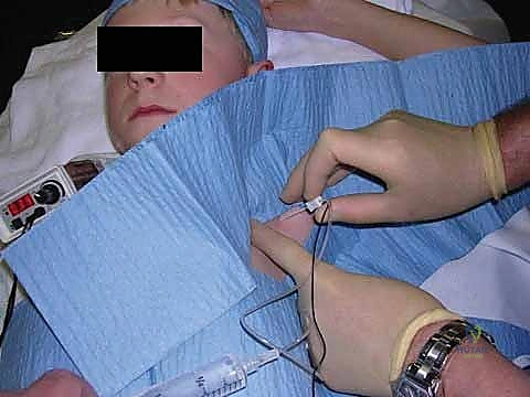 توضيح مسارات الأعصاب في الطرف العلوي