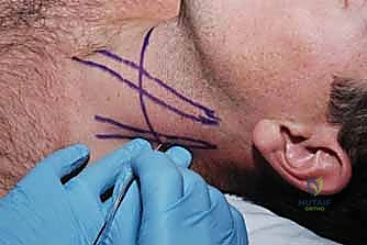 صورة توضيحية لتشريح الطرف العلوي والضفيرة العضدية