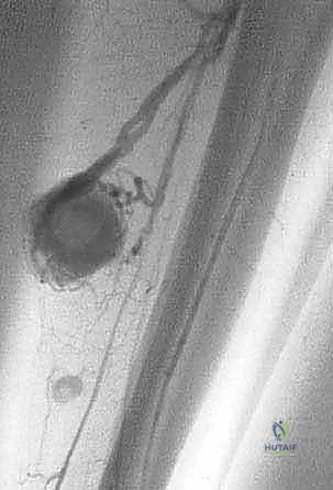 صورة توضيحية لـ فهم خزعة أورام الجهاز العضلي الهيكلي: دليل شامل للمرضى مع الأستاذ الدكتور محمد هطيف