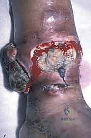 أهمية التشخيص الدقيق لأورام العظام