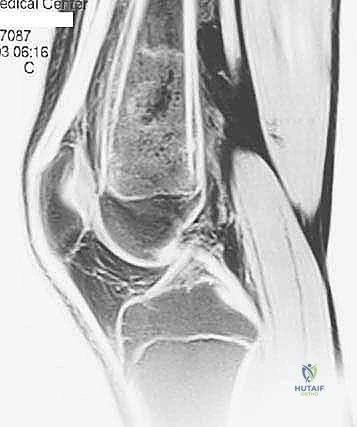 إغلاق جرح الخزعة بضمادة معقمة