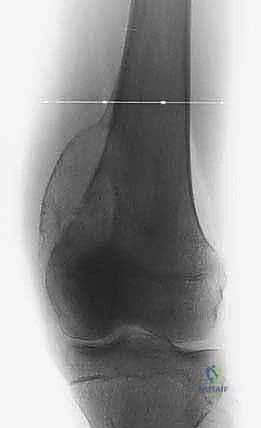 التخطيط الجراحي لمسار الخزعة