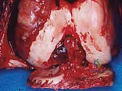 استئصال الورم بالكامل في الحالات الحميدة