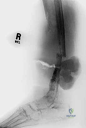 توجيه الإبرة بالأشعة للحصول على عينة دقيقة