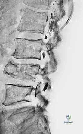 دراسة الأشعة المقطعية قبل الجراحة