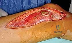 استخراج العينة النسيجية من الورم