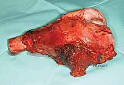 فهم خزعة أورام الجهاز العضلي الهيكلي: دليل شامل للمرضى مع الأستاذ الدكتور محمد هطيف